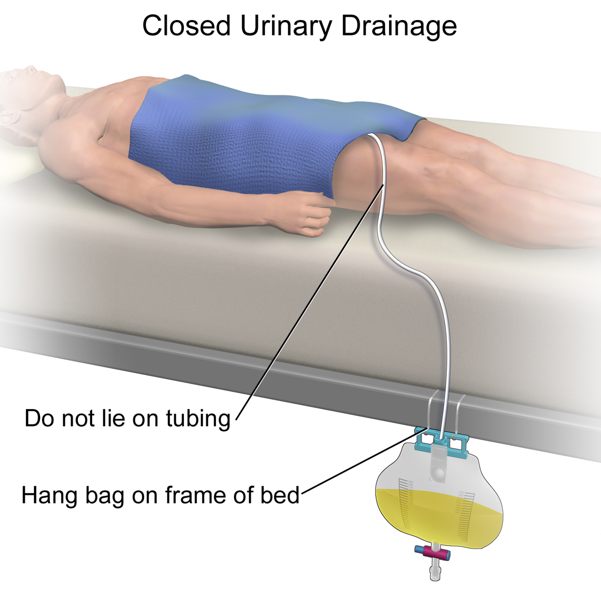How Do You Change A Catheter Bag To A Leg Bag at Hector Best blog