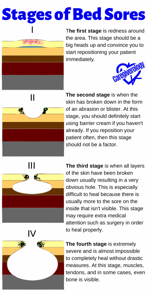 Stages of Bed Sores