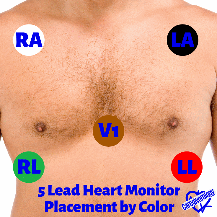 5 Lead Heart Monitor Placement by Color