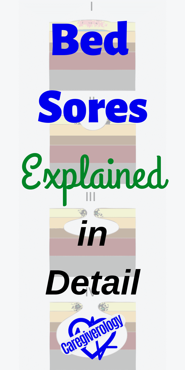 Bed sores explained in detail