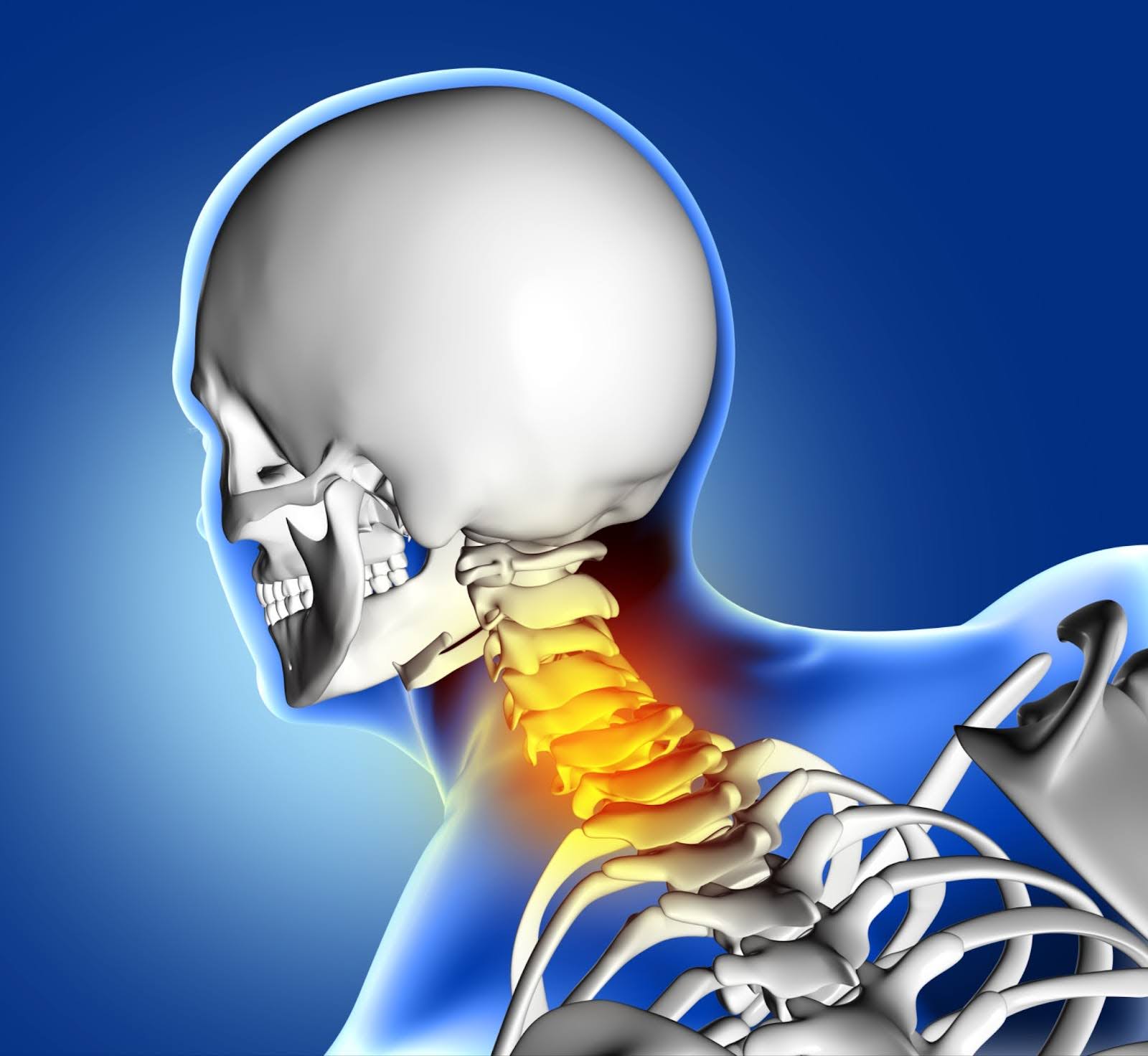 cervical spondylosis 1